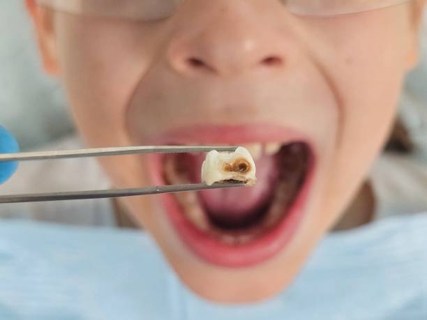 Best Emergency Dental Care for Abscessed Tooth in Brookdale, NJ